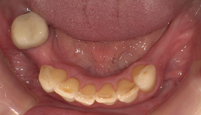 BEFORE