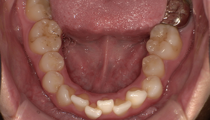 BEFORE
